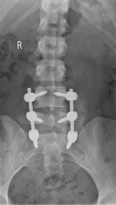 Away with Pain About-chronic pain X-ray 1