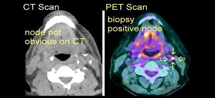 PET Scan